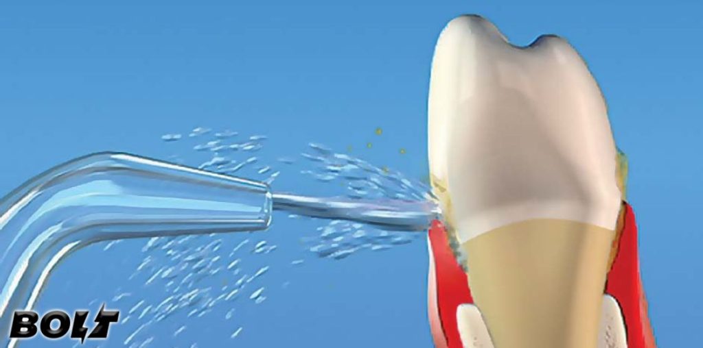 how to get rid of periodontal disease