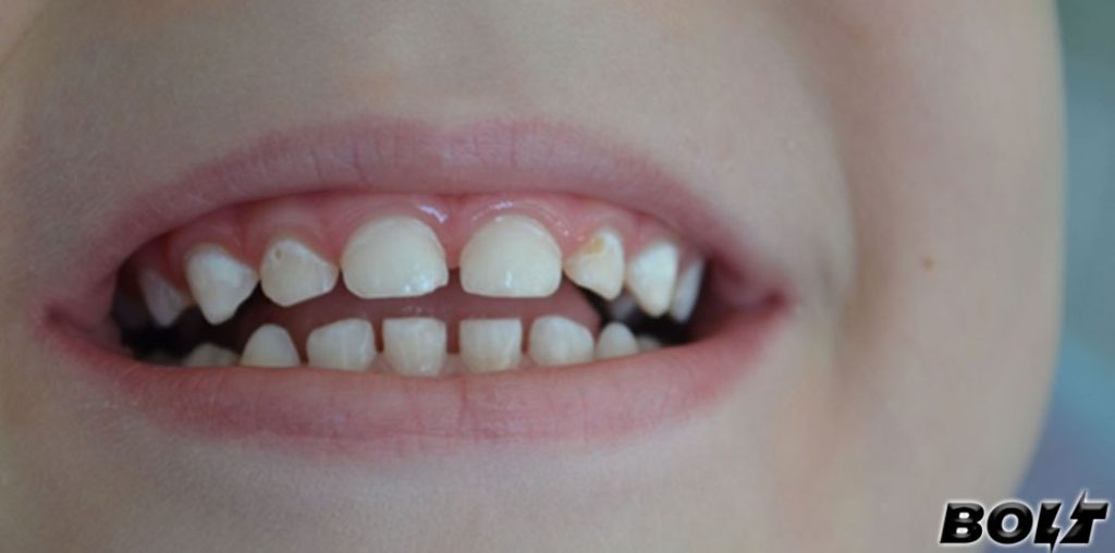 white spots on teeth